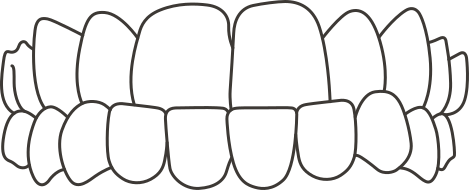Underbite