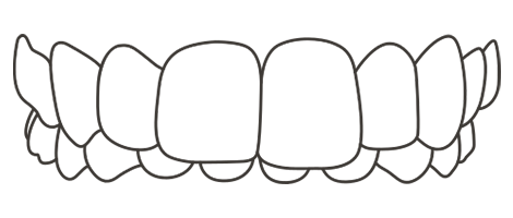 Overbite