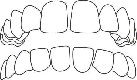 Gap teeth