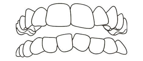 Crowded Teeth