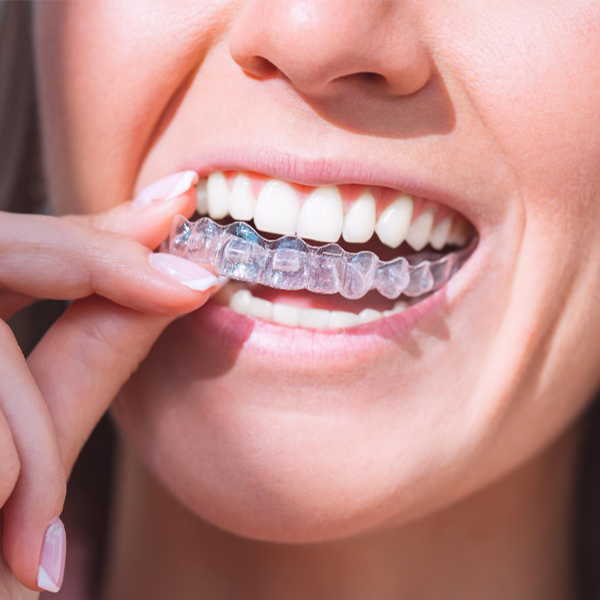 Invisalign Clear Aligners